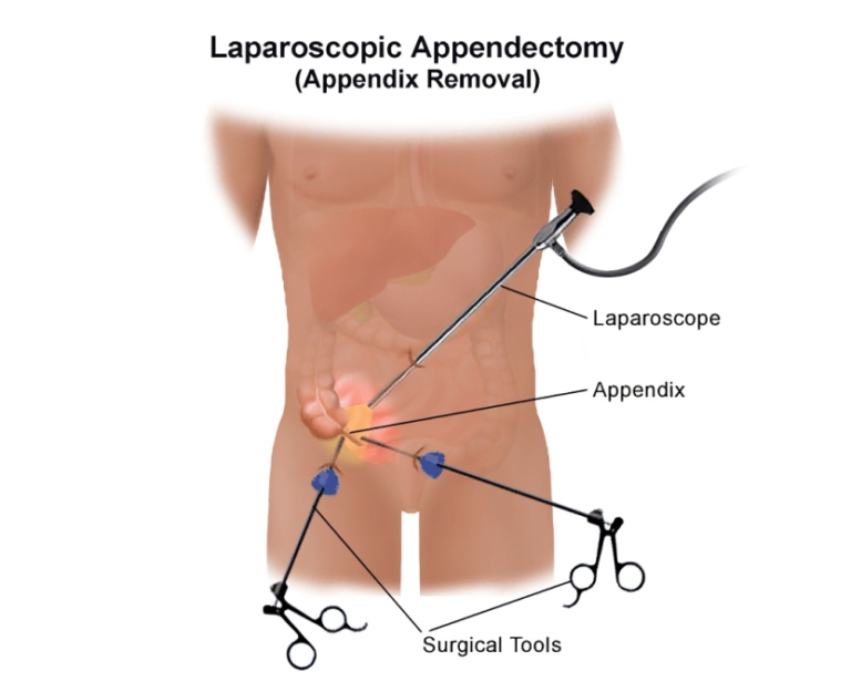 Laparoscopic Appendectomy: A Minimally Invasive Approach to Appendicitis Treatment.