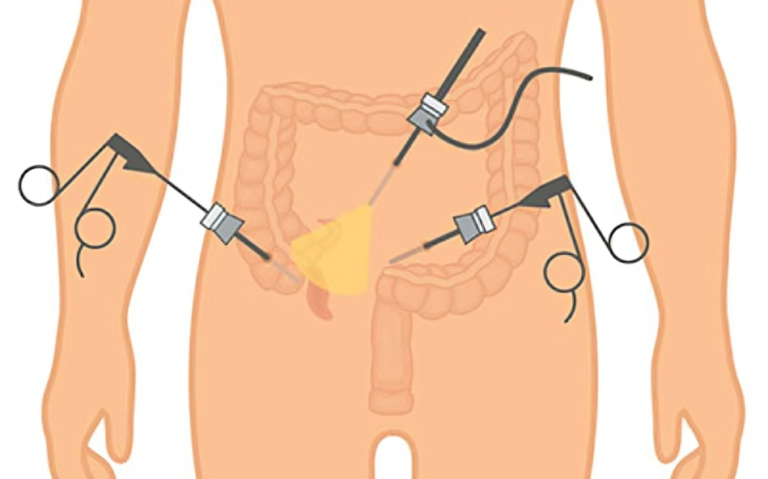 Appendicitis Alleviation The Advantages of Laparoscopic Appendectomy.