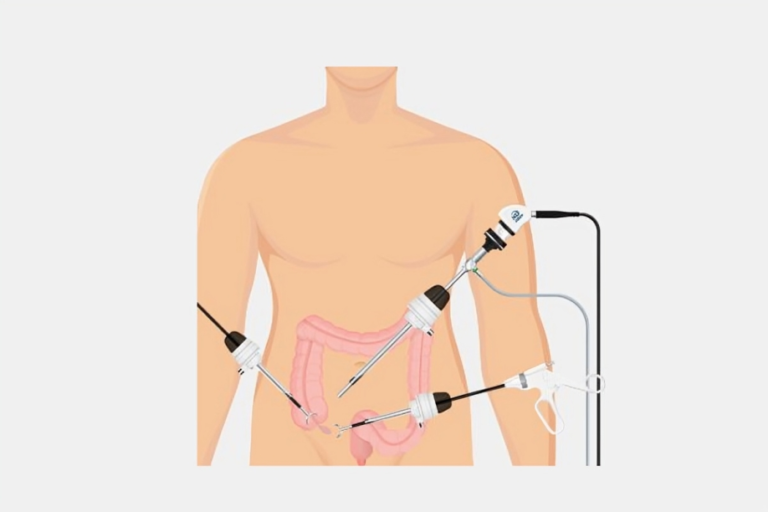 Laparoscopic Cholecystectomy: A Minimally Invasive Approach to Gallbladder Removal.