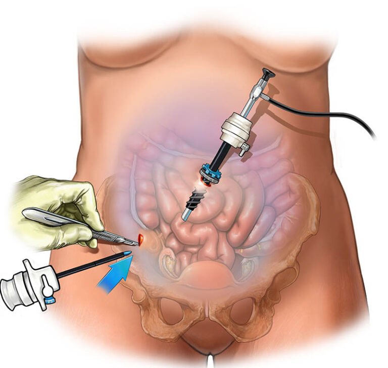 Laparoscopic Appendectomy: Revolutionizing Appendicitis Treatment with Surgical Precision.