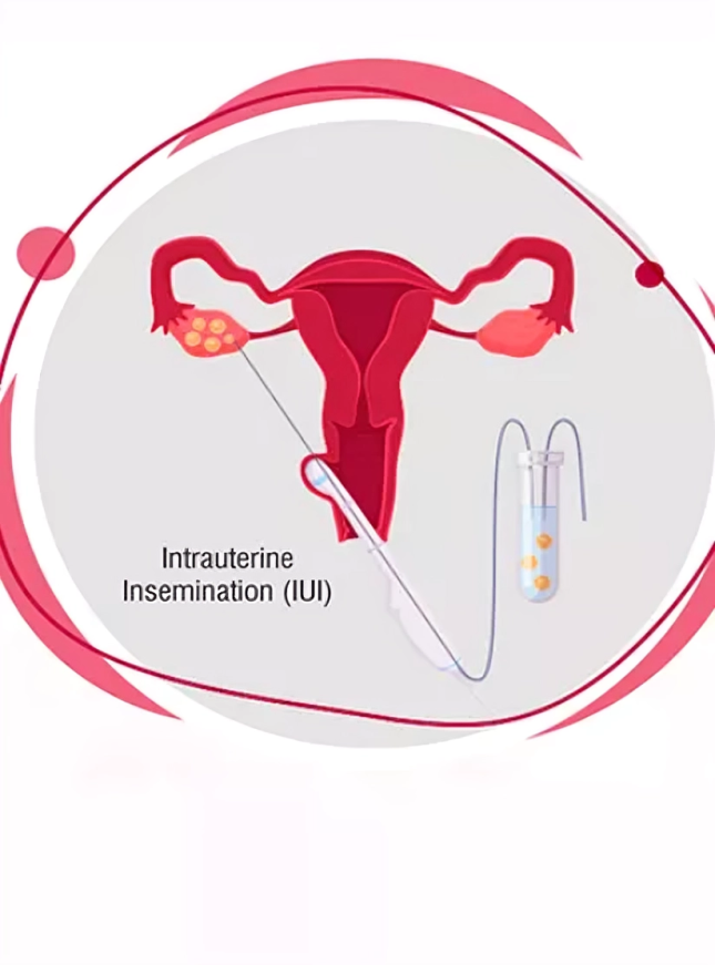 Unlocking Parenthood: A Deep Dive into Intrauterine Insemination (IUI) for Enhanced Fertility.