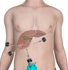 A Gentle Approach to Gallbladder Care: Laparoscopic Cholecystectomy Reshapes Surgical Landscape.