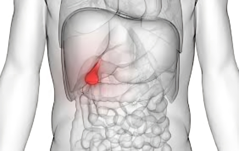 The Minimally Invasive Wave of Laparoscopic Cholecystectomy.