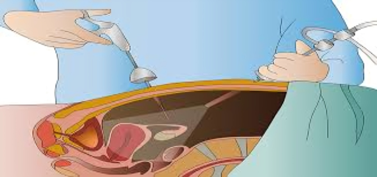 Innovative Solutions for Gallbladder Woes: Laparoscopic Cholecystectomy Leads the Way.