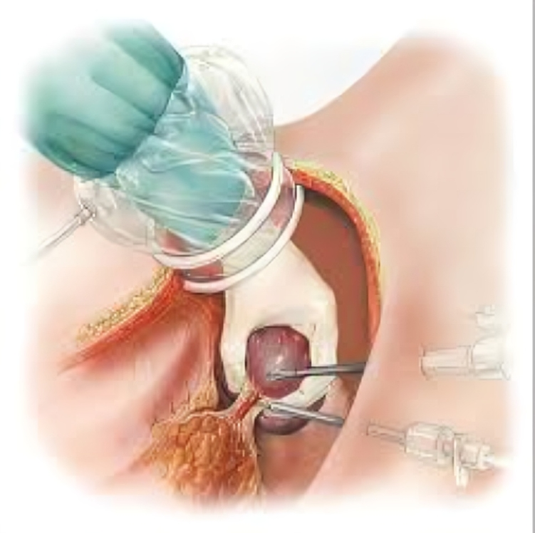 Beyond Traditional Surgery: Laparoscopic Appendectomy’s Triumph in Easing Appendicitis