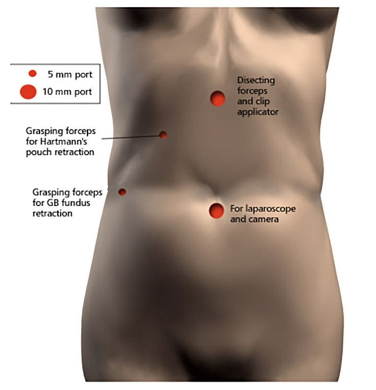 Exploring the Benefits of Minimally Invasive Laparoscopic Cholecystectomy for Gallbladder Removal.