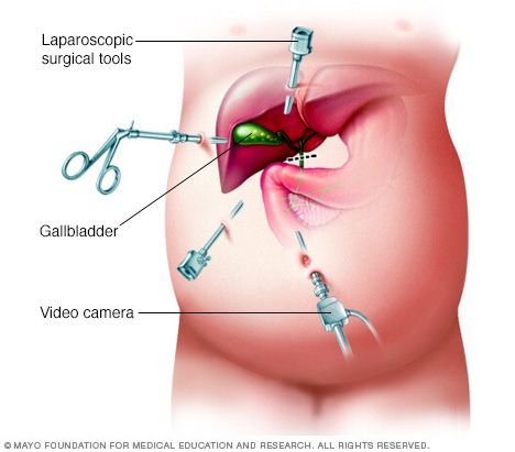 Ethical And Legal Issues In Laparoscopic Cholecystectomy