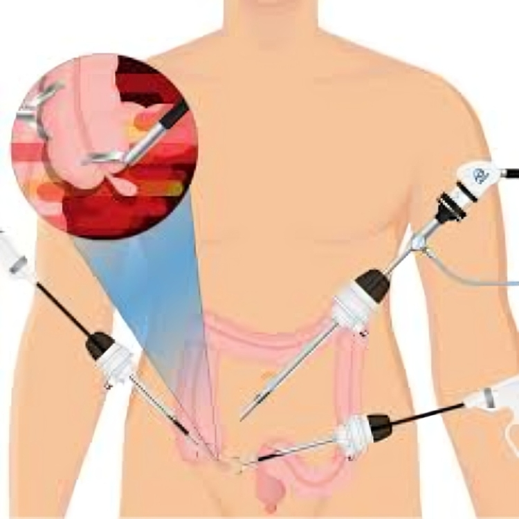 Preparing For Laparoscopic Appendectomy: What To Expect